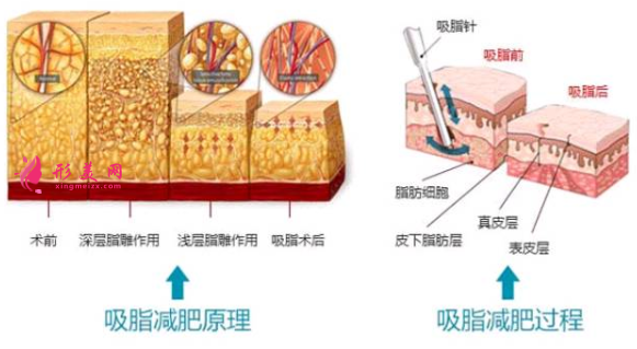 吸脂減肥過程痛不痛