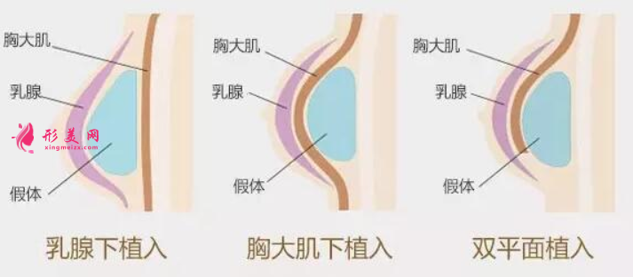 假體隆胸型號怎么選擇