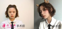 北京圣嘉新醫(yī)療美容醫(yī)院做面部吸脂如何？我也可以擁有小V臉