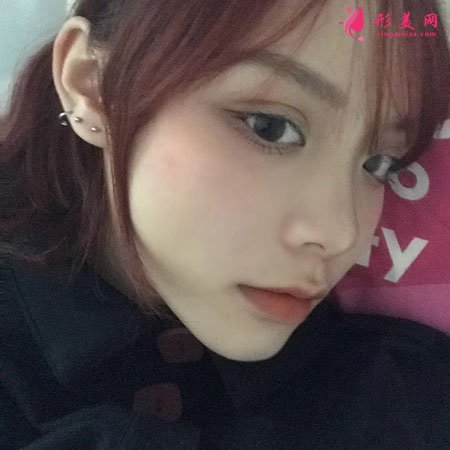 北京藝美面部吸脂案例術后25天