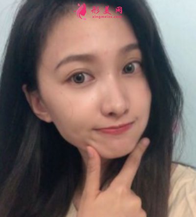 鄭州東方整形醫(yī)院雙眼皮修復(fù)案例