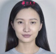 鄭州附二院楊麗雙眼皮修復(fù)效果如何？真人案例分享