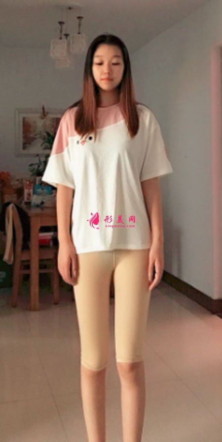 重慶美圣美邦醫(yī)療美容整形吸脂瘦大腿案例