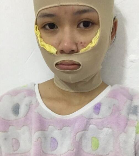上海九院顴骨內(nèi)推多少錢？全新價格表來襲！附案例分享