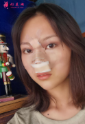 北京彤美整形醫(yī)院鼻綜合全方位改造塌鼻子
