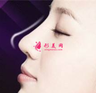 軟骨隆鼻術(shù)前需要做什么準(zhǔn)備