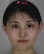 深圳市第二人民醫(yī)院整形美容科瘦臉針案例_案例術(shù)后效果實拍分享