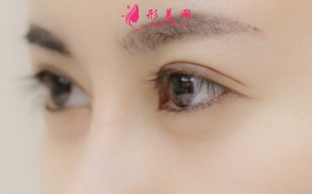 雙眼皮手術(shù)痛不痛呢