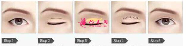 雙眼皮埋線和切開(kāi)有什么區(qū)別