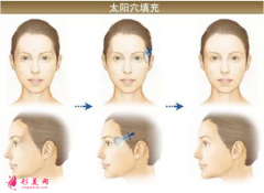 自體脂肪填充臉部后的注意事項