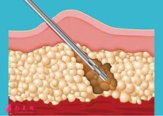 腰腹部吸脂術(shù)后護(hù)理要注意什么