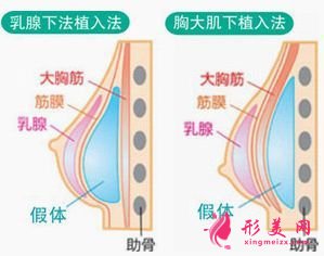 假體隆胸對(duì)身體有什么危害嗎