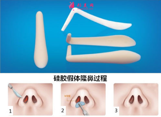 假體隆鼻術(shù)后的相關(guān)護(hù)理事項(xiàng)有哪些