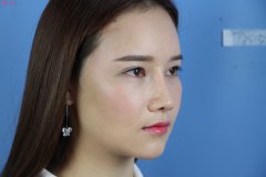 玻尿酸填充臉部的優(yōu)勢有哪些？
