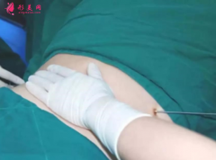 腰腹部吸脂需要住院嗎？