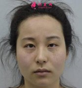 南京友誼整形外科醫(yī)院眼袋祛除效果好嗎？案例實拍圖全告訴你