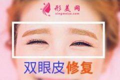 長沙雅美整形醫(yī)院做雙眼皮修復(fù)怎么樣？