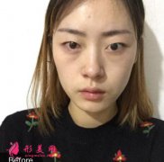 深圳富華醫(yī)院眼綜合效果咋樣!案例效果及價格表一覽