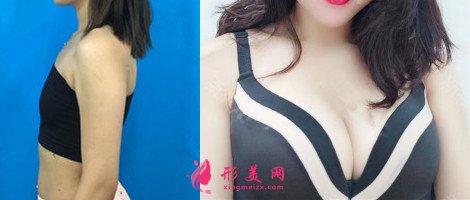 鄭州集美美容醫(yī)院隆胸案例