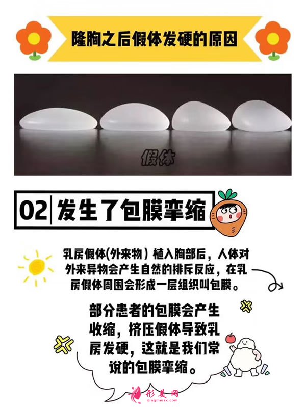 假體隆胸術(shù)后會(huì)不會(huì)發(fā)生包膜攣縮.jpg