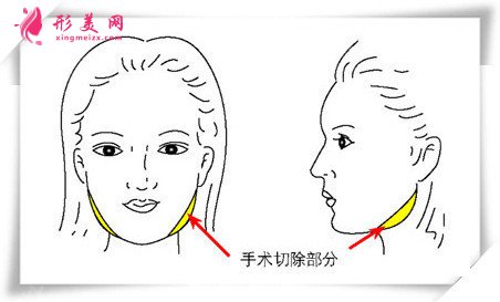 下頜角手術(shù)部位 下頜角手術(shù)部位