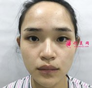 上海華美醫(yī)院硅膠隆鼻怎么樣？來看看術(shù)后案例在說效果吧！