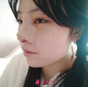 北京八大處范飛做隆鼻怎么樣？附隆鼻術(shù)后90天恢復(fù)過程圖