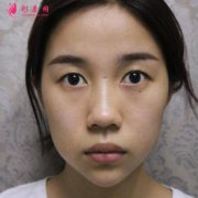 廣州荔醫(yī)雙眼皮好嗎？效果怎么樣？術(shù)后90天恢復(fù)效果圖分享
