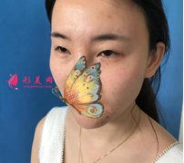 四川米蘭柏羽整形醫(yī)院雙眼皮兒怎么樣？案例效果圖在線一覽