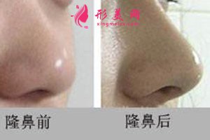 隆鼻前后對(duì)比圖 隆鼻前后對(duì)比圖