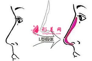 假體隆鼻