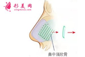 鼻中隔軟骨