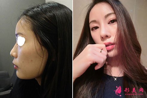 韓國普瑞美整形醫(yī)院隆鼻真人案例