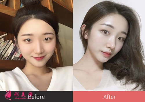 韓國普瑞美整形醫(yī)院隆鼻案例