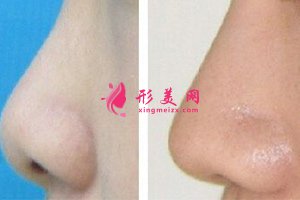 隆鼻 隆鼻