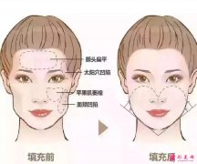 脂肪填充面部半年后會下垂是真的嗎？