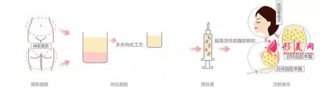 自體脂肪填充流程