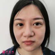 重慶五洲整形隆鼻怎么樣？附隆鼻恢復(fù)對比案例~