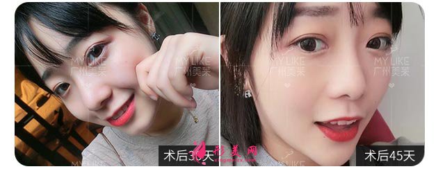 雙眼皮手術(shù)是怎么做的