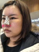 上海九院整形科怎么樣？附隆鼻恢復(fù)真實(shí)效果圖分享