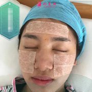 廣州南方醫(yī)院脂肪填充怎么樣？面部脂肪填充案例恢復(fù)照片和價格分