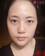 廣西醫(yī)科大第一附屬醫(yī)院瘦臉針案例效果圖！附2021價(jià)格標(biāo)準(zhǔn)