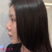 北京煤炭總醫(yī)院整形科怎么樣？附隆鼻恢復(fù)效果圖前后對比