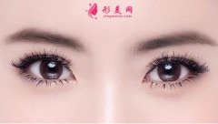 全切雙眼皮和埋線雙眼皮哪個(gè)效果更好?埋線雙眼皮好不好?