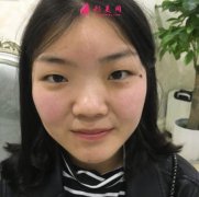 北京煤炭總醫(yī)院雙眼皮怎么樣？眼部整形案例在線一覽