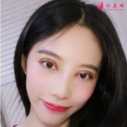 成都恒博天姿醫(yī)療美容雙眼皮怎么樣？案例圖術(shù)后恢復(fù)記錄新公開(kāi)