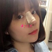 北京藝星隆鼻怎么樣？附隆鼻恢復(fù)過(guò)程一覽