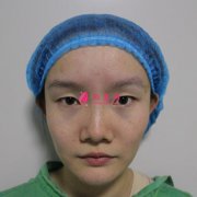 杭州時(shí)光范眉清割雙眼皮怎么樣？真人案例術(shù)后三個(gè)月效果展示