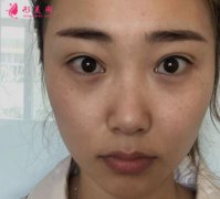 廣州曙光割雙眼皮怎么樣？看看我的案例~術(shù)后兩個(gè)月效果很贊哦！