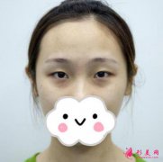上海九院整形科割雙眼皮怎么樣？案例效果圖+收費(fèi)標(biāo)準(zhǔn)參考